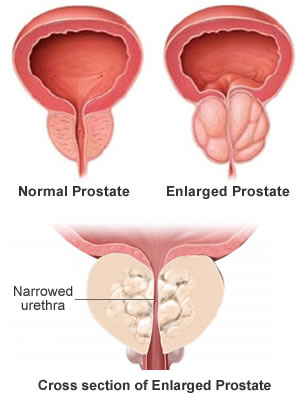 Prosztata – Wikipédia